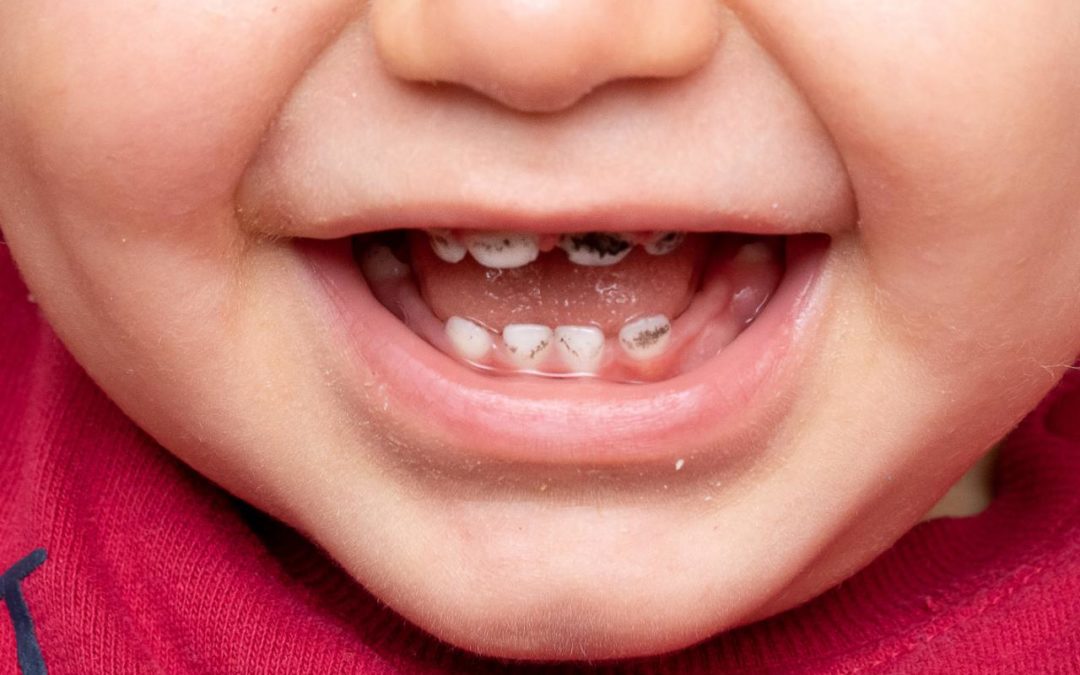 How to Remove Stains on Children’s Teeth | Utah Pediatric Dentists