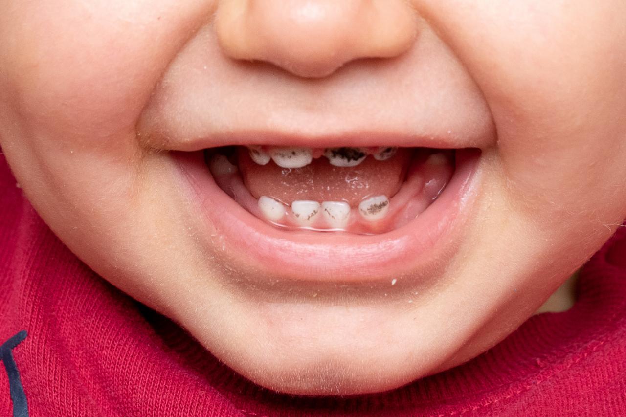 How To Remove Stains On Childrens Teeth Utah Pediatric Dentists