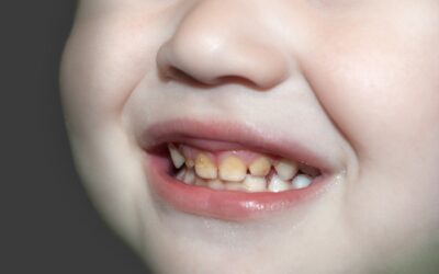 Why Are My Child’s Teeth Coming in Yellow?