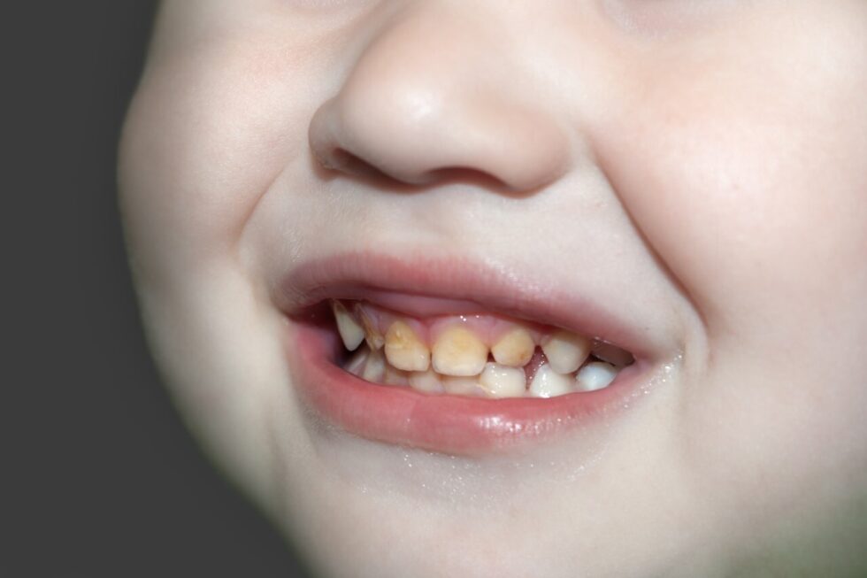 why-are-my-child-s-teeth-yellow-while-coming-in-pediatric-dentistry