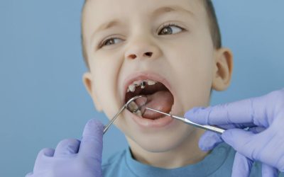 Understanding Pulpotomies: A Lifesaver for Your Child’s Teeth